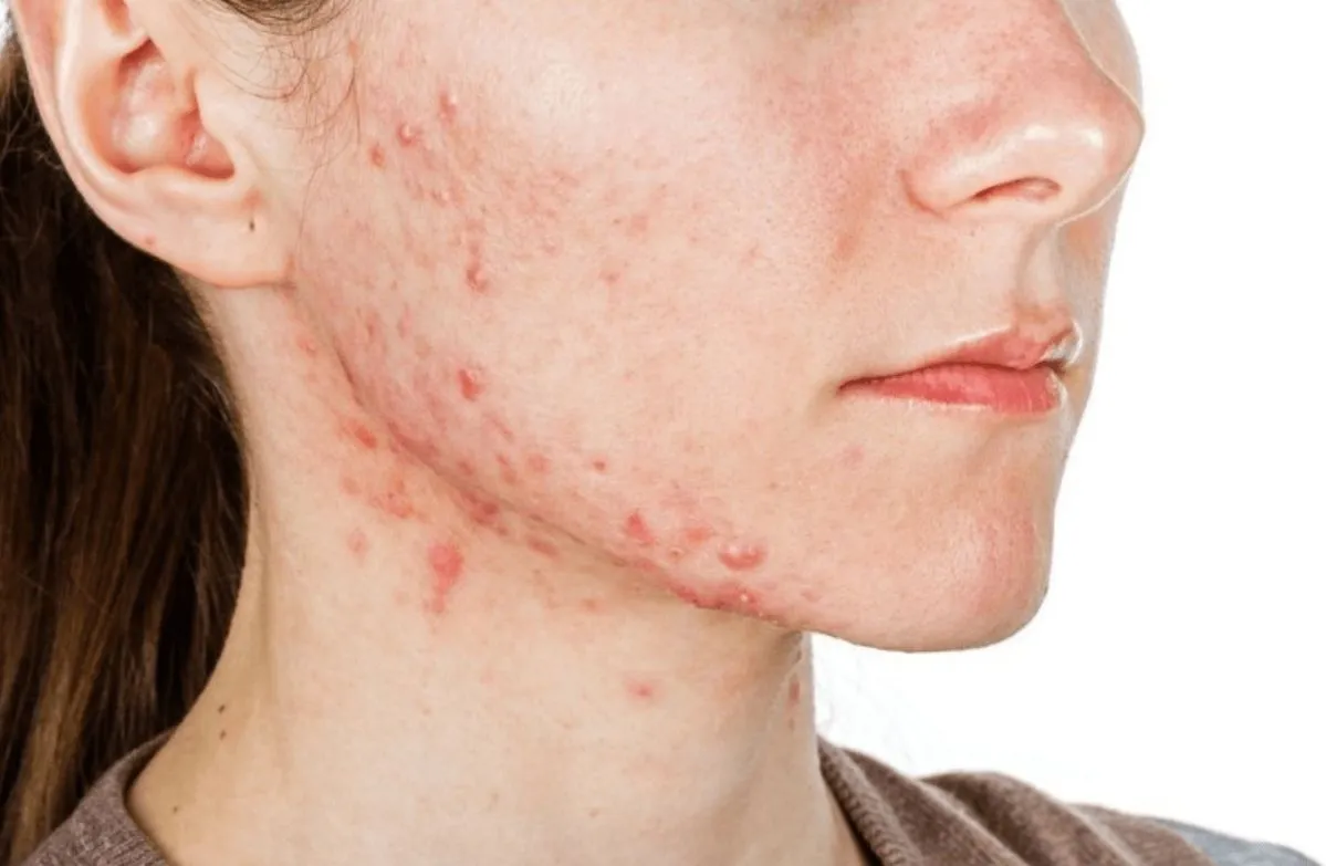 Cystic Acne and pimple
