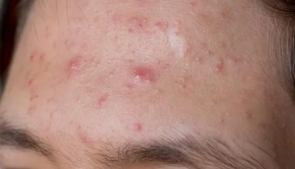 Hormonal Acne and pimple