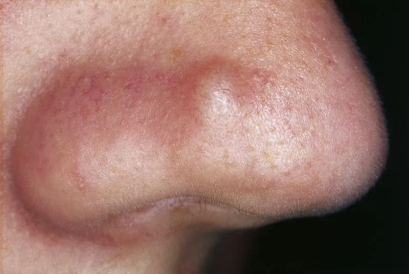 papules acne treatment