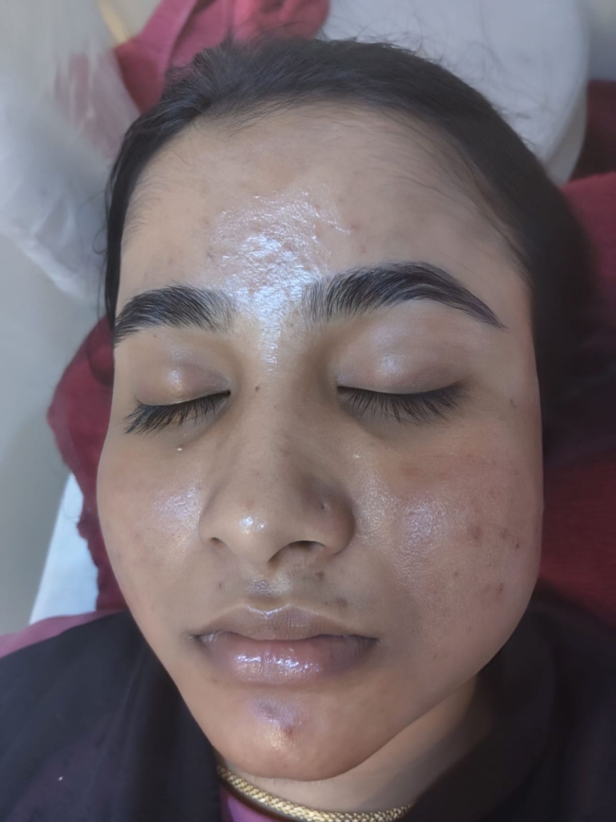 After single sitting acne with pigmentation concern treatment at our dermatology clinic in Kasba