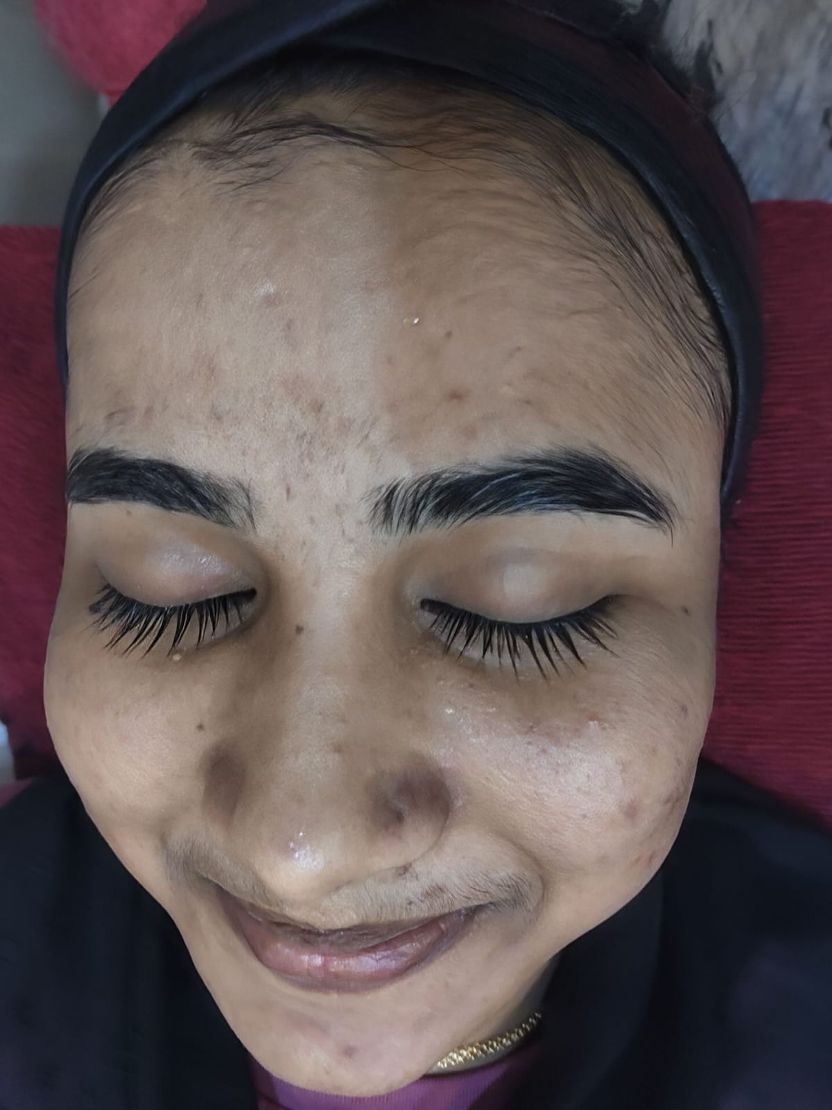 Before single sitting acne with pigmentation concern treatment at our dermatology clinic in Kasba