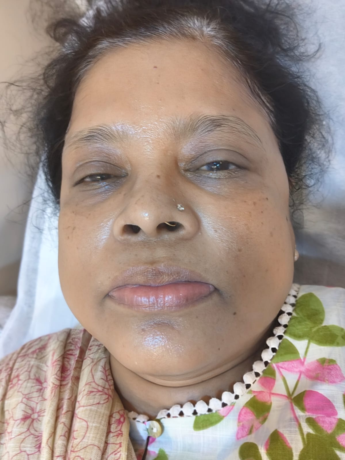 after pigmentation with dehydrated concern