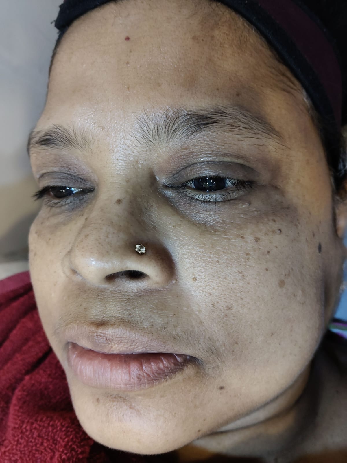 before pigmentation with dehydrated concern