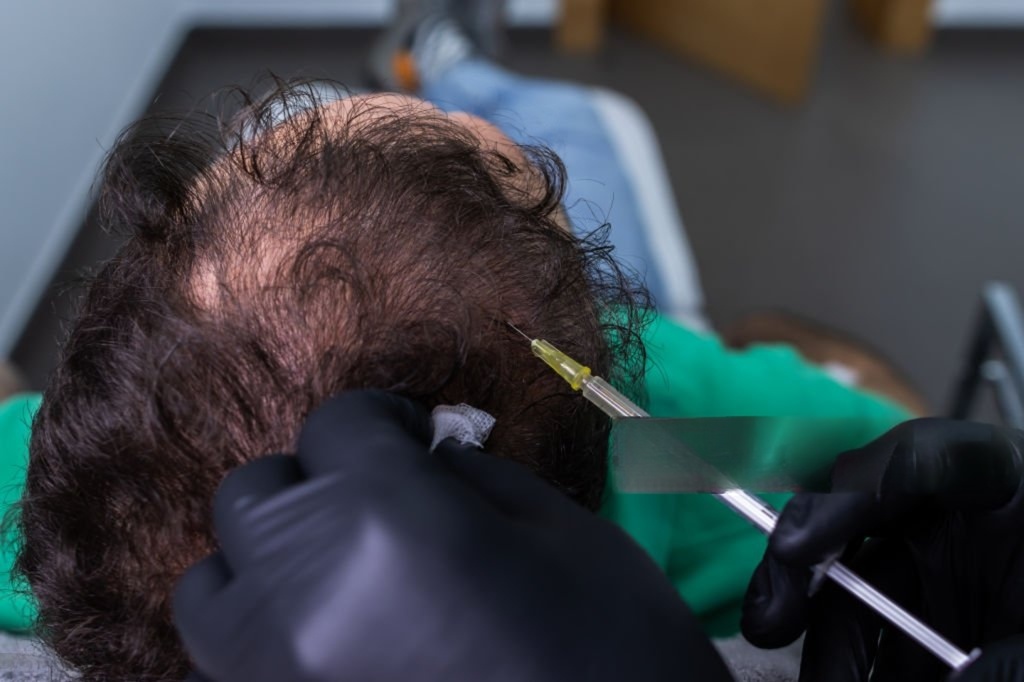Hair PRP Treatment