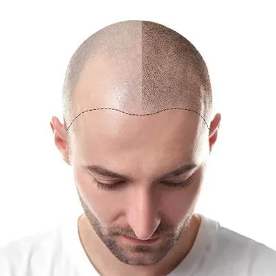 Hair Transplant