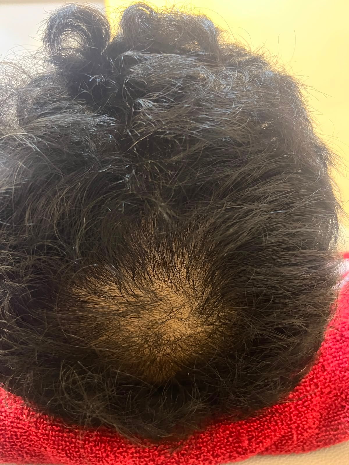 Hair Prp Treatment After