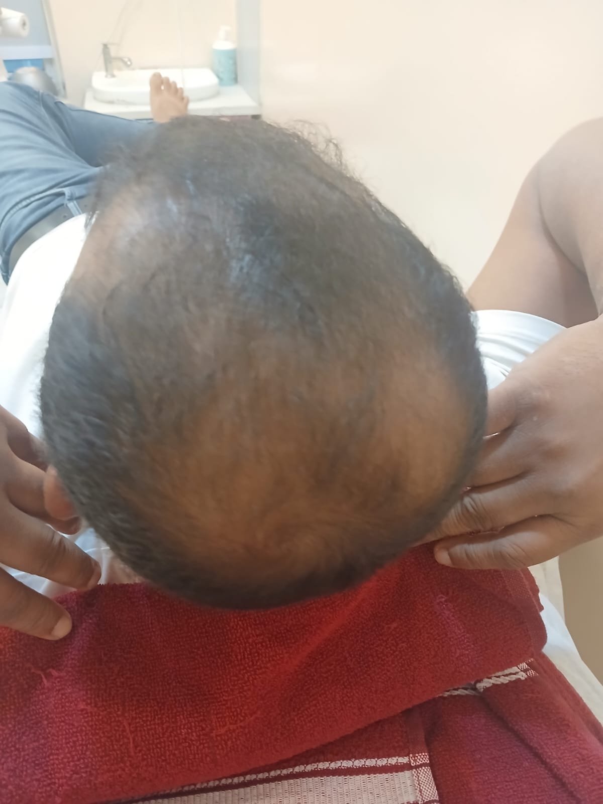 Hair Prp Treatment Before
