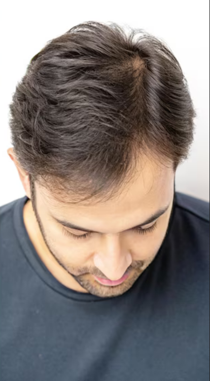 Hair Prp Treatment for Hair Fall After