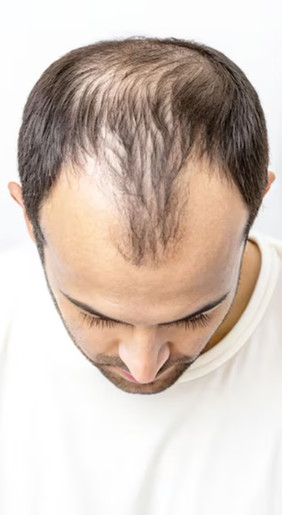 Hair Prp Treatment for Hair Fall Before