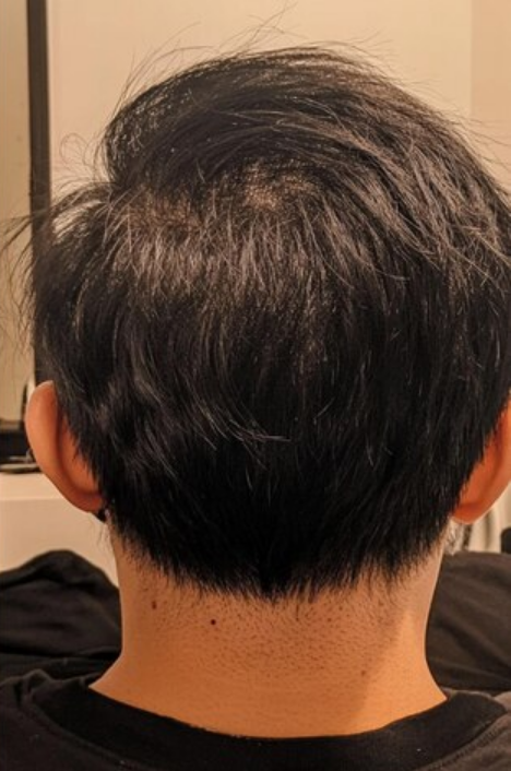 Hair Prp Treatment for Hair Loss After